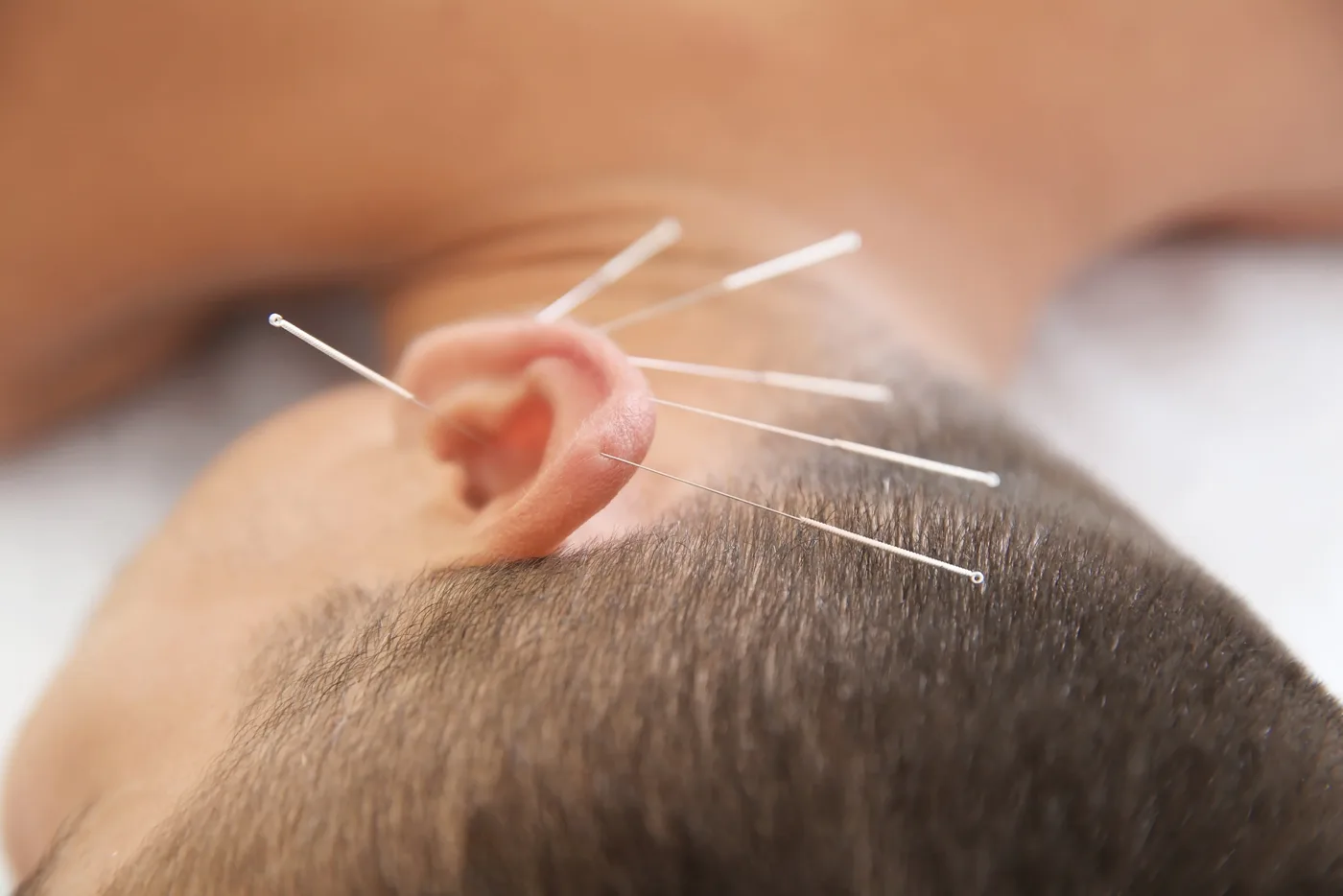 Ear Acupuncture (Auriculotherapy) at Sesto Senso, holistic wellness centre in Limassol