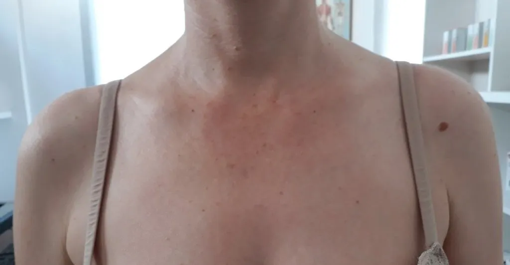 After treatment