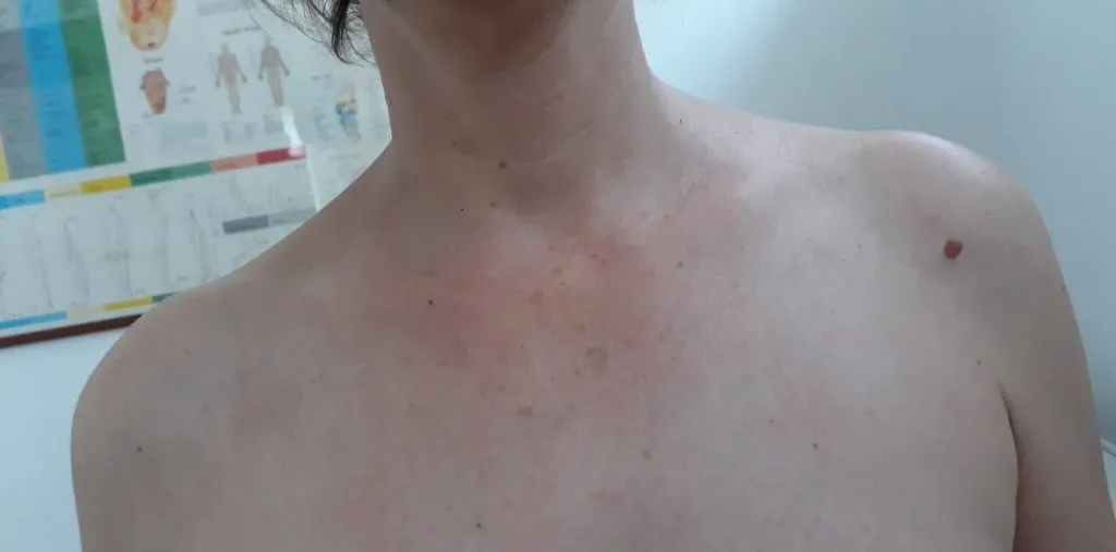Before treatment